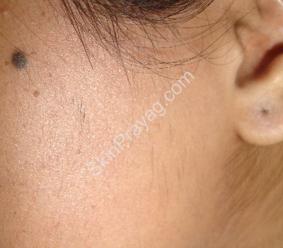 laser hair removal after picture