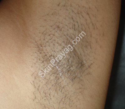 laser hair removal in Delhi Rohini
