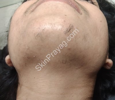 Laser Hair Reduction