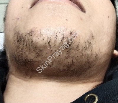 Laser Hair Reduction