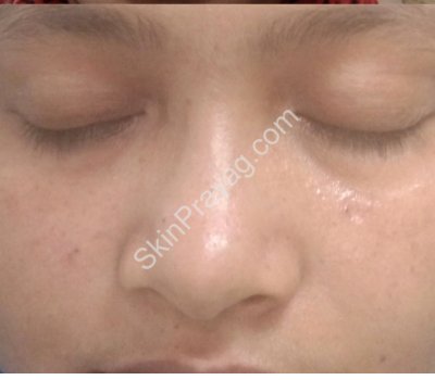 Mole Removal
