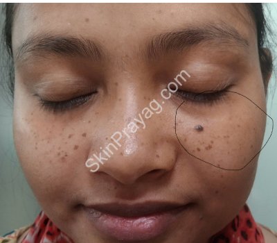 mole removal with CO2 laser & freckle removal with Q switched Nd YAG laser
