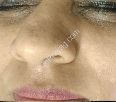 Mole Removal