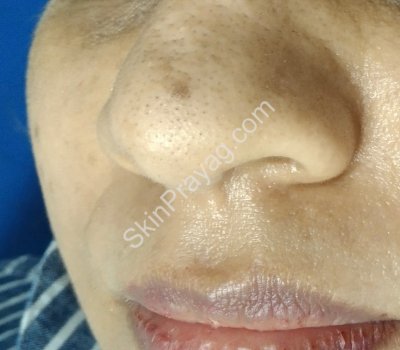 Mole Removal