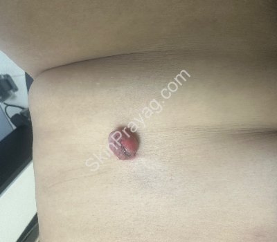 Skin Tag Removal