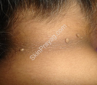 Skin Tag Removal