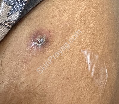 Skin Tag Removal