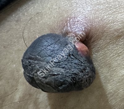 Skin Tag Removal