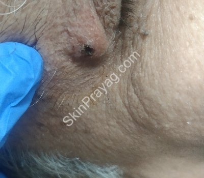 Eyelid skin tag removal-after