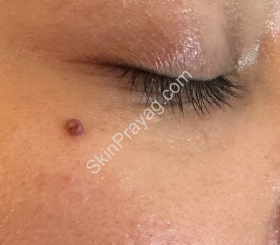 Mole Removal