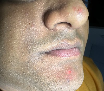 Mole Removal
