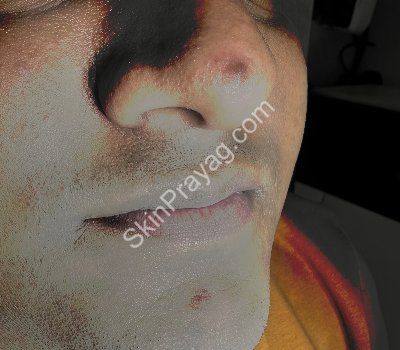 Mole Removal