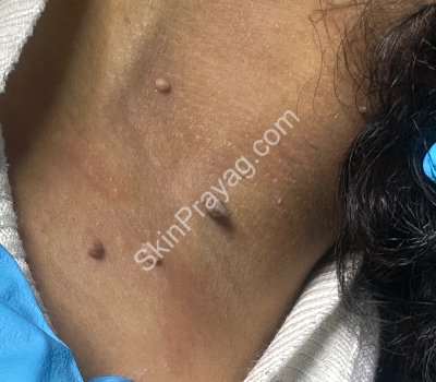 Skin Tag Removal