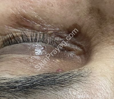 Xanthelasma removal