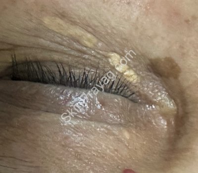 Xanthelasma removal