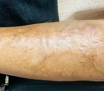 Scar removal treatment