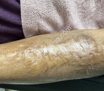 Scar removal treatment