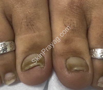 Fungal nail infection treatment