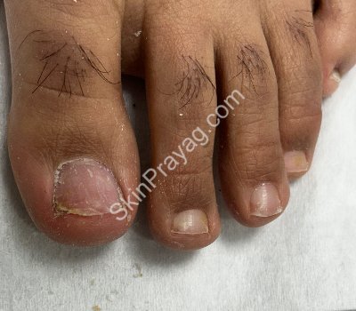 After debridement with Bur &Q switched Nd YAG treatment