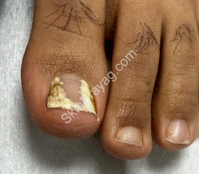 Before debridement with Bur & Q switched Nd YAG treatment