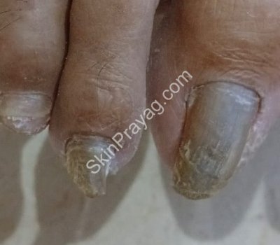 After debridement with Bur &Q switched Nd YAG treatment