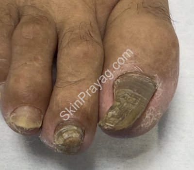 Before debridement with Bur & Q switched Nd YAG treatment