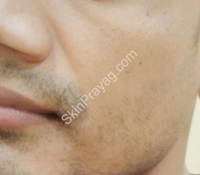 Volume correction in mid face BEFORE