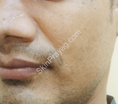 Volume correction in midface AFTER