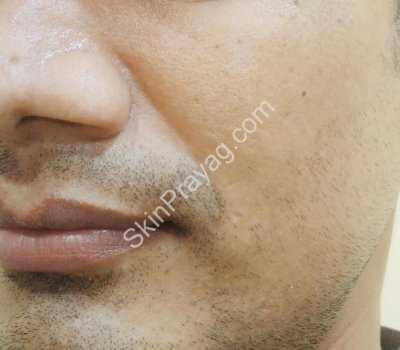Volume correction midface AFTER