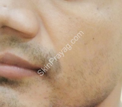 Volume correction midface BEFORE