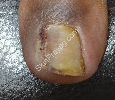 Ingrown toe nail treatment After, Delhi