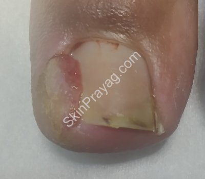 Ingrown toe nail treatment Before , Delhi