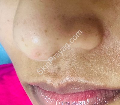 After wart removal, Rohini, Delhi