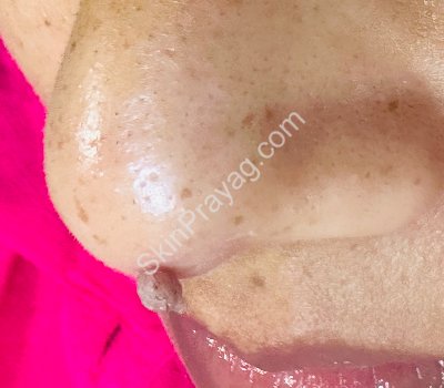 Before wart removal ,Rohini, Delhi