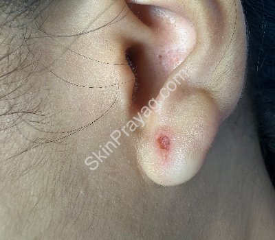 Immediately after keloid removal