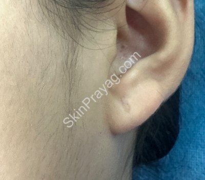 After ear lobe keloid removal with CO2 laser