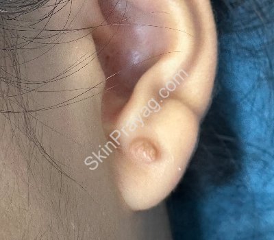 Before ear lobe keloid removal with CO2 laser