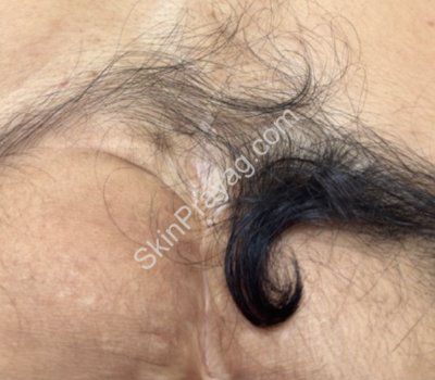 Before laser hair reduction, Rohini , Delhi