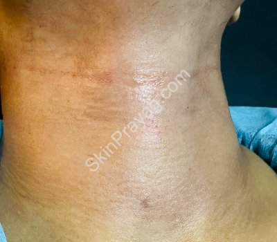 After skin booster treatment neck, Rohini , Delhi