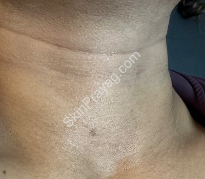 Before skin booster treatment neck , Rohini ,Delhi