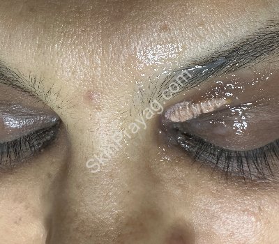 Immediately After phenolization of xanthelasma