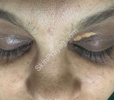 Before phenolization of xanthelasma