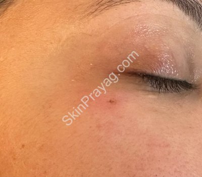 After mole removal with CO2 laser removal