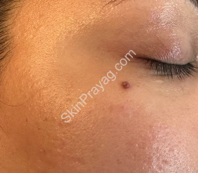 Before mole removal with CO2 laser removal