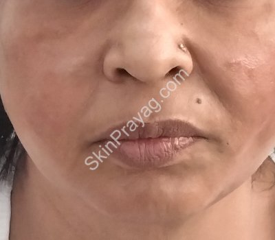 Threadlift treatment