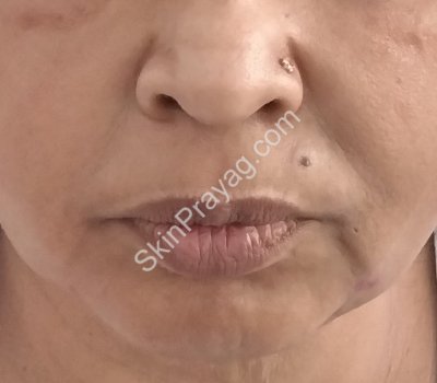Threadlift treatment