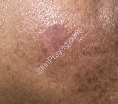 After removal of plane warts, Rohini, Delhi