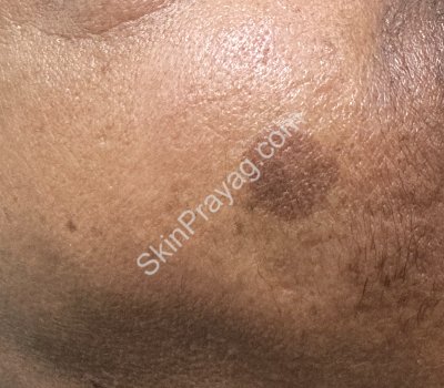 Before removal of plane warts, Rohini, Delhi