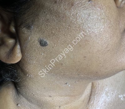 Skin Tag Removal