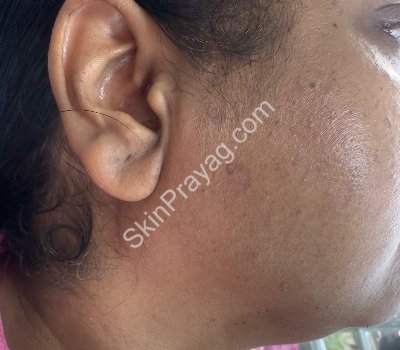 After removal of skin tags, seborrheic keratoses
